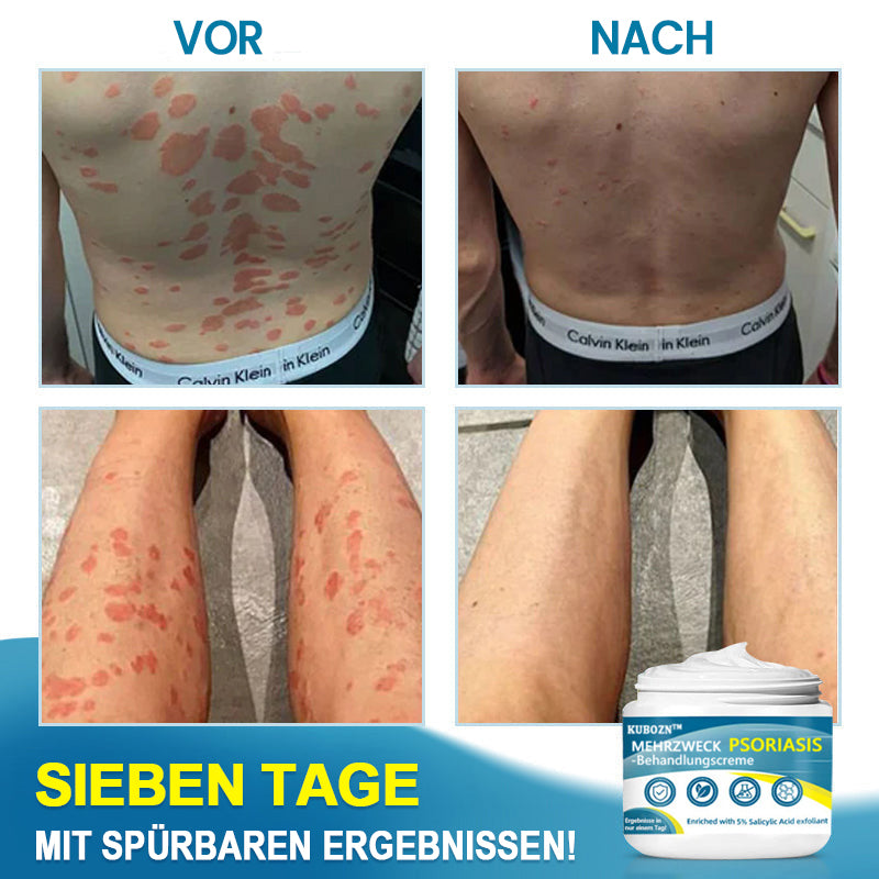 KUBOZN™ Fortschrittliche Multi-Symptom Psoriasis-Behandlungscreme 👨‍⚕️ Von Dermatologen empfohlen