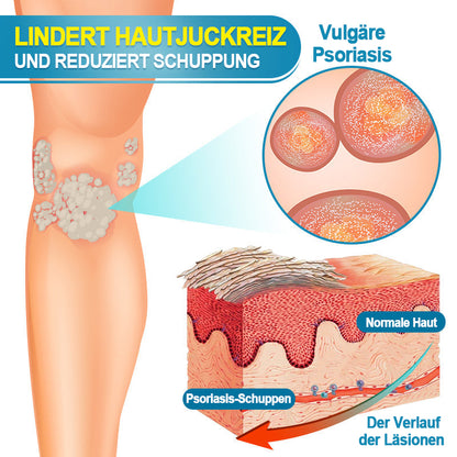 KUBOZN™ Fortschrittliche Multi-Symptom Psoriasis-Behandlungscreme 👨‍⚕️ Von Dermatologen empfohlen