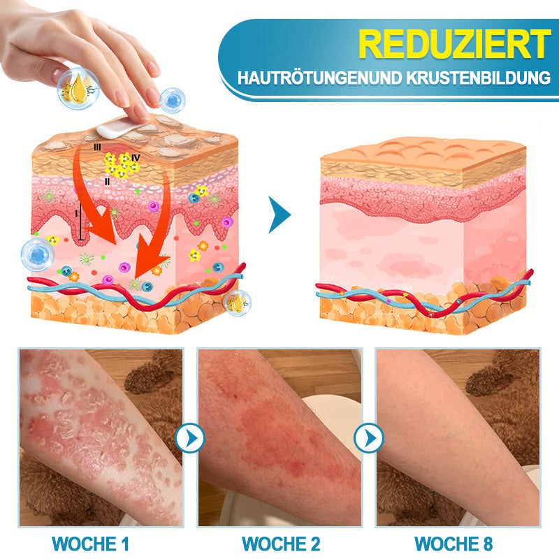 KUBOZN™ Fortschrittliche Multi-Symptom Psoriasis-Behandlungscreme 👨‍⚕️ Von Dermatologen empfohlen