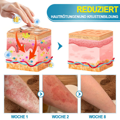 KUBOZN™ Fortschrittliche Multi-Symptom Psoriasis-Behandlungscreme 👨‍⚕️ Von Dermatologen empfohlen